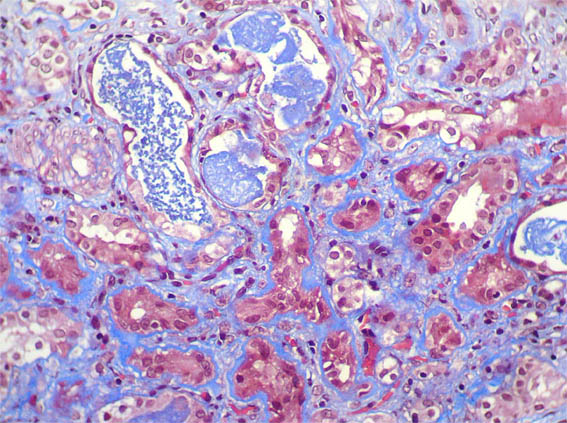 Paediatric Nephrotic Syndrome